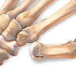 Trapeziectomy and Tightrope.jpg