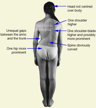 Scoliosis Ascot Vale Moonee Ponds