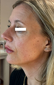 Fullface fillersbehandling i ansiktet på kvinna, resultat är ett piggare och ungdomligt utseende.