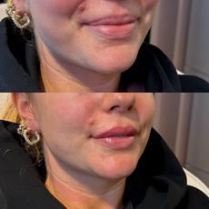 Resultat av läppförstoring med fillers där läpparna fått mer volym och jämnare form.