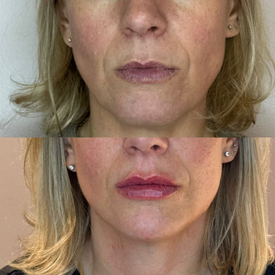 Före och efterbild på en fullface filler behandling med naturligt resultat.