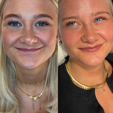 Två kvinnor före och efter estetisk behandling med fräschare hudton och mer lyster.