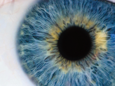 An Eye on Cataracts