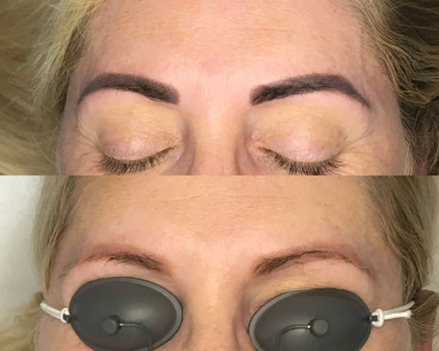 Laser tattoo removal before and after cosmetic eyebrows – Clean Skin Laser Brisbane