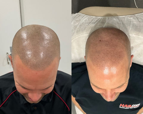 Laser tattoo removal before and after SMP – Clean Skin Laser Brisbane