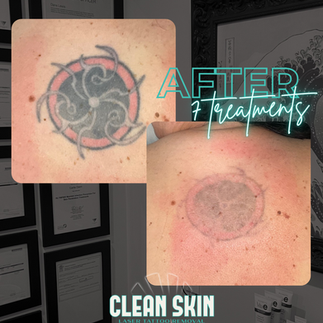 Before and after professional tattoo removal in Brisbane