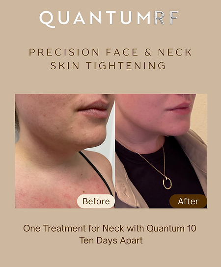 Quantum 10 Face Neck Before After.png