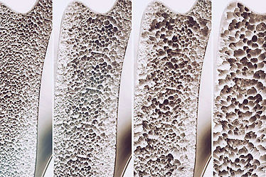 osteoporosis-progressive-examples-bones-612x612.jpg