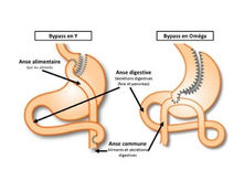 Tout savoir sur le Bypass Gastrique - Maximisez votre perte de poids