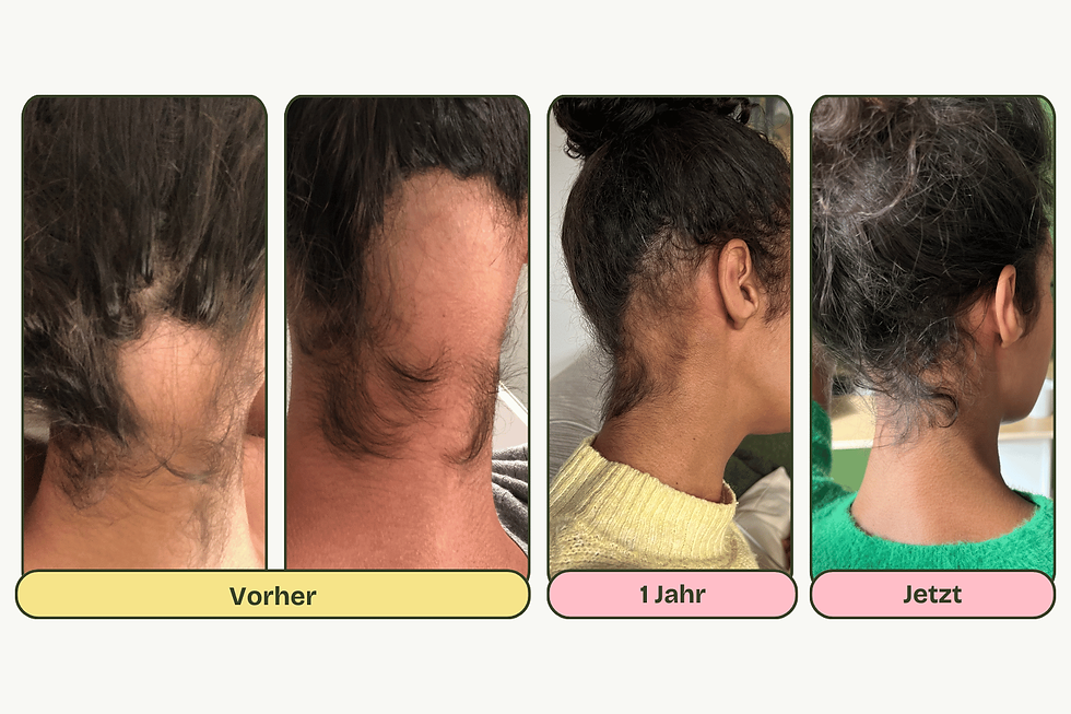 Das Bild zeigt eine dreiteilige Darstellung des Haarwachstumsprozesses über die Zeit, mit den Phasen „Vorher“, „1 Jahr“ und „Jetzt“. Im „Vorher“-Bild ist deutlicher Haarausfall im Nackenbereich zu sehen. Nach einem Jahr ist ein gewisses Haarwachstum zu erkennen, und im „Jetzt“-Bild sind die Haare im Bereich des Haarausfalls deutlich dichter geworden. Die Entwicklung zeigt eine sichtbare Verbesserung des Haarwuchses im Verlauf der Zeit.