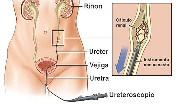 Ureteroscopia.jpg