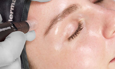 Exo Booster Microneedling Image 1.jpg
