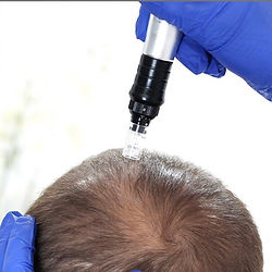 PRP administered onto scalp to assist in hair regrowth