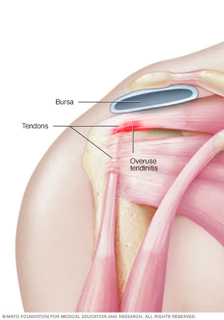 tendinitis_edited.jpg