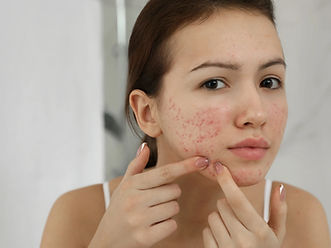 acne pimples