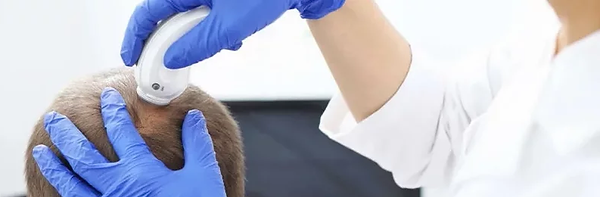 Trapianto Capelli con medici turchi