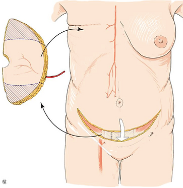 Reconstruction mammaire par DIEP