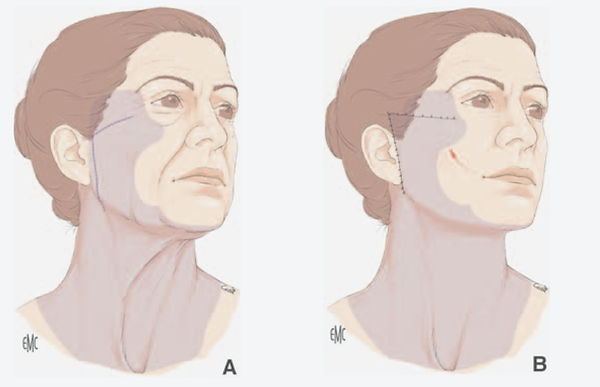 Lifting cervico-facial