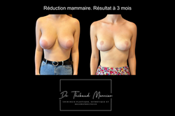 Réduction mammaire