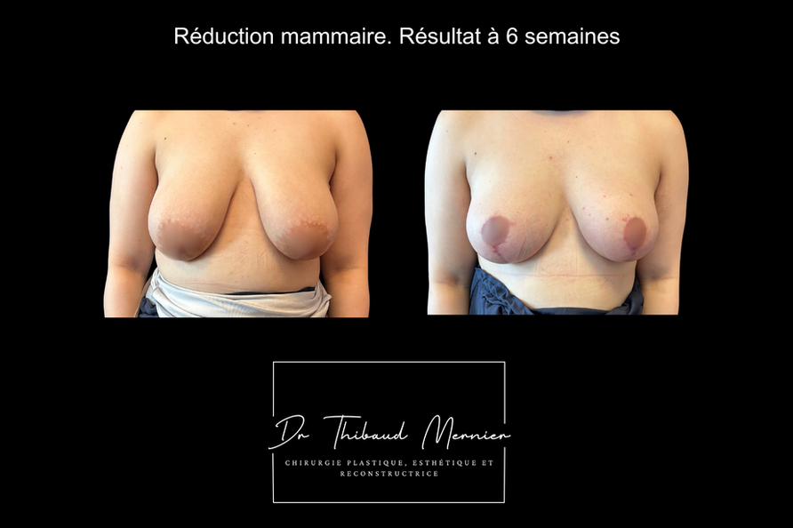 Réduction mammaire Paris