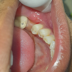 IMPLANT PLACEMENT IN 25 YEAR OLD MAN WHO LOST HIS TEETH DUE TO CARIES