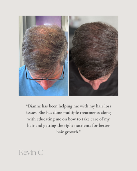 Hair loss before and after results showing improved density after treatment at Dianne Sitar Hair Laconia NH