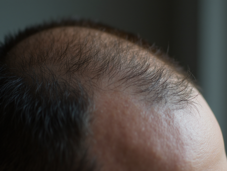 Exploring Effective Solutions for Hair Thinning and Female Hair Loss