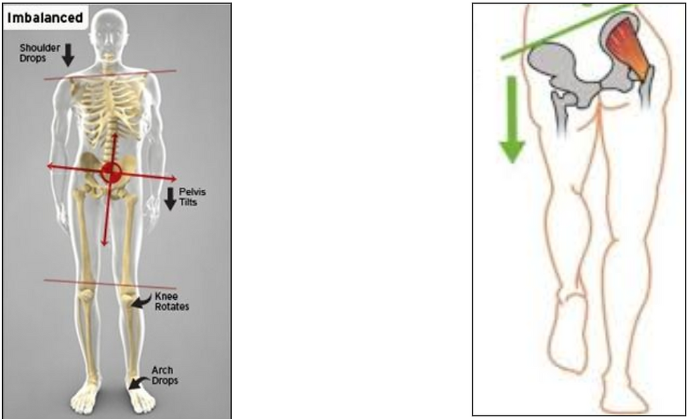 image showing weak or imbalanced pelvis