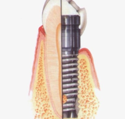 Implantes Odontológicos: o que são?
