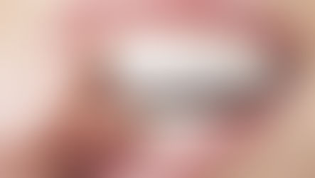 Diferenças entre Limpeza e Clareamento