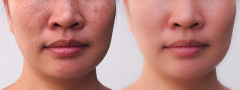 Micorneedling Model for Allswell Wellness LLC