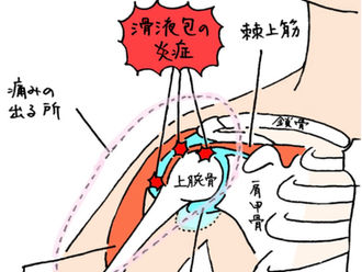 ◆長年の肩痛　肩関節周囲炎