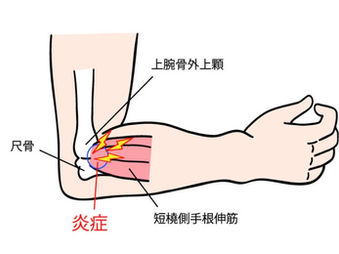 日常生活でも起こる　テニス肘