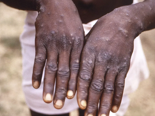 Mãos de pessoa com Mpox
