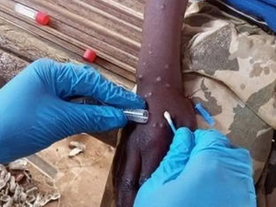 Profissional da saúde coleta amostra de pele de pessoa com Mpox