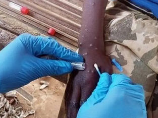 Profissional da saúde coleta amostra de pele de pessoa com Mpox