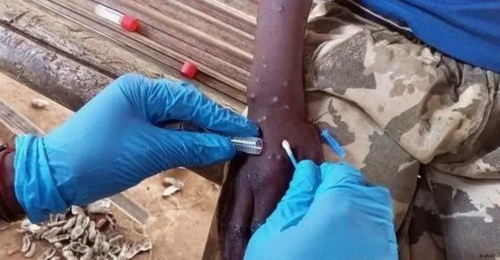 Profissional da saúde coleta amostra de pele de pessoa com Mpox