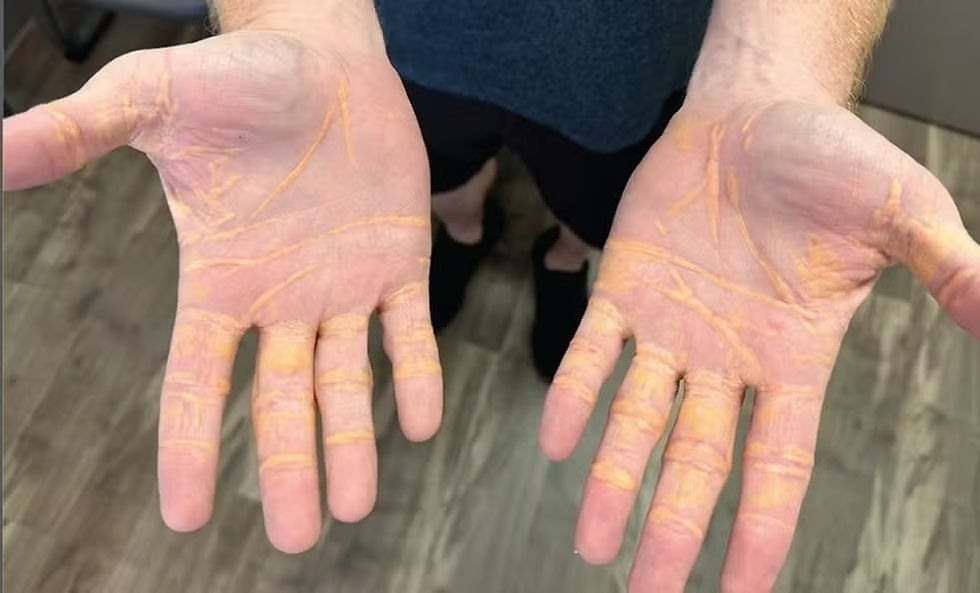 Marcas amareladas aparecem ao redor das linhas das mãos estendidas
