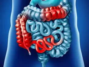 Crohn, Doença de