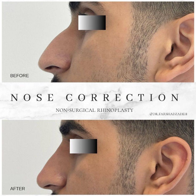 non-surgical Nose Correction Before After Dubai