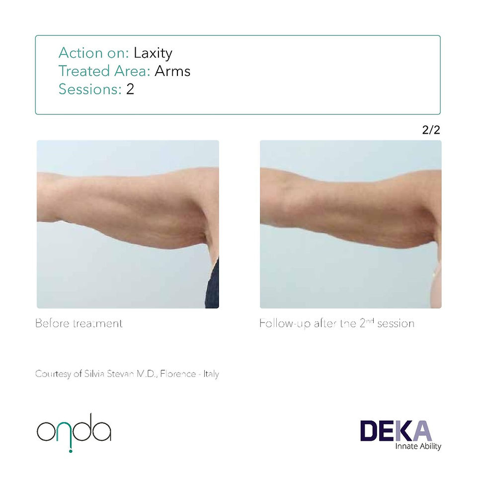 ONDA DUBAI arms fat reduction before after skin tightening cellulite 