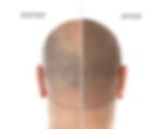 Scarred scalp in Dubai concealed with SMP for a seamless appearance.