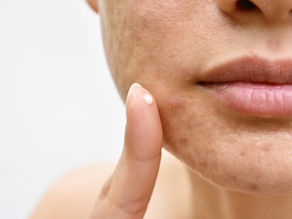 Acne Scar Treatment with Fat Grafting 