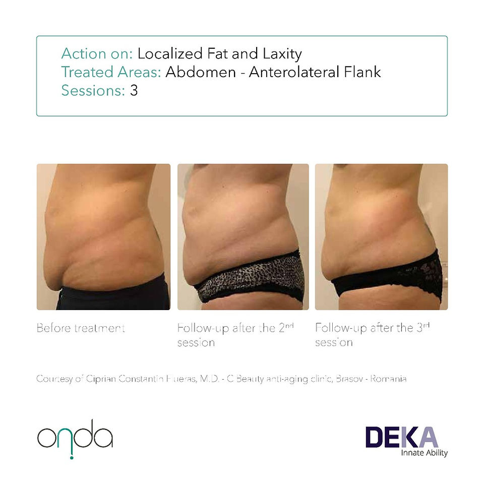 ONDA abdomen coolwaves fat reduction before after Dubai