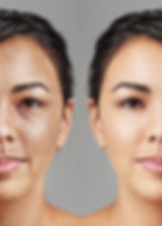 Botox Results Before and After