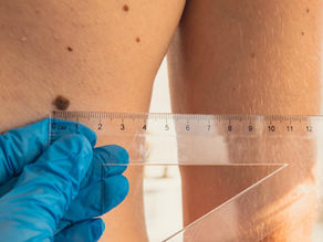 Mole Mapping in Dubai: Early Skin Cancer detection