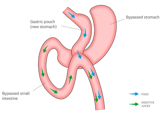 GASTRIC BY PASS