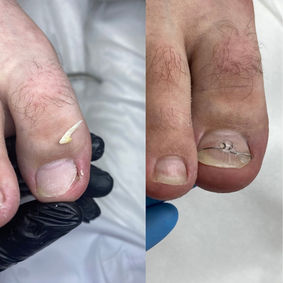 До и после установки скобы фрезера для корректировки ногтя подологом Алевтиной в Ереване
