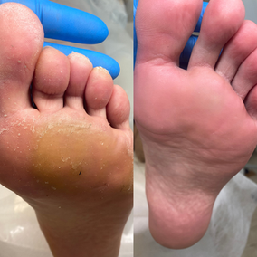 Обработка стоп ноги во время гигиенического педикюра подологом Алевтиной в Ереване