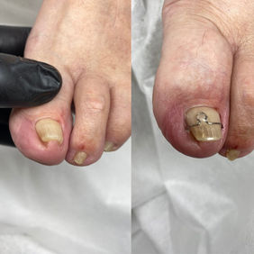 До и после установки скобы фрезера на ноготь для его выпрямления, работа выполнена в Ереване подологом Томской А. В.